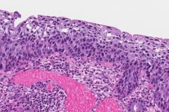 High grade squamous intraepithelial lesion of the cervix