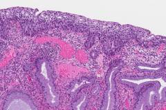 High grade squamous intraepithelial lesion of the cervix