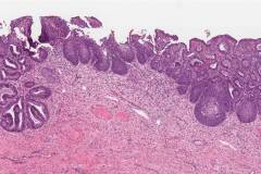 High grade squamous intraepithelial lesion and adenocarcinoma in situ of the cervix