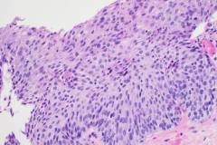 High grade squamous intraepithelial lesion of the vagina