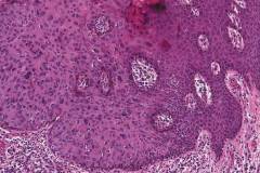 High grade squamous intraepithelial lesion of the vulva