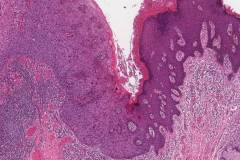 High grade squamous intraepithelial lesion of the vulva