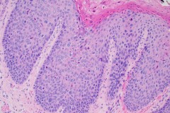 High grade squamous intraepithelial lesion of the vulva