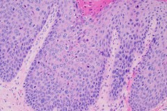 High grade squamous intraepithelial lesion of the vulva