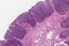 HPV associated squamous dysplasia of the larynx