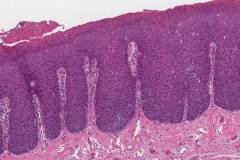 HPV-associated oral dysplasia