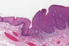 HPV-associated oral dysplasia