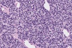 HPV-associated multiphenotypic sinonasal carcinoma