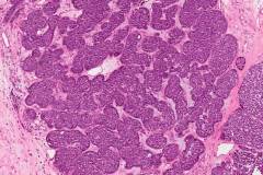 HPV-associated multiphenotypic sinonasal carcinoma