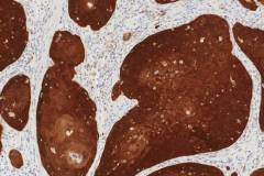 HPV associated squamous cell carcinoma of the oral cavity: Immunohistochemistry for p16.