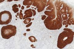 HPV associated squamous cell carcinoma of the oral cavity: Immunohistochemistry for p16.