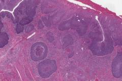 HPV associated squamous cell carcinoma of the oral cavity