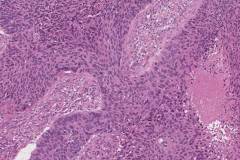 HPV-associated nonkeratinizing squamous cell carcinoma in the oral cavity