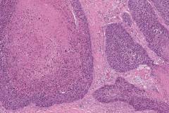 HPV-associated nonkeratinizing squamous cell carcinoma in the oral cavity