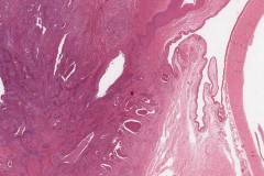 HPV associated nonkeratinizing squamous cell carcinoma of the lacrimal duct