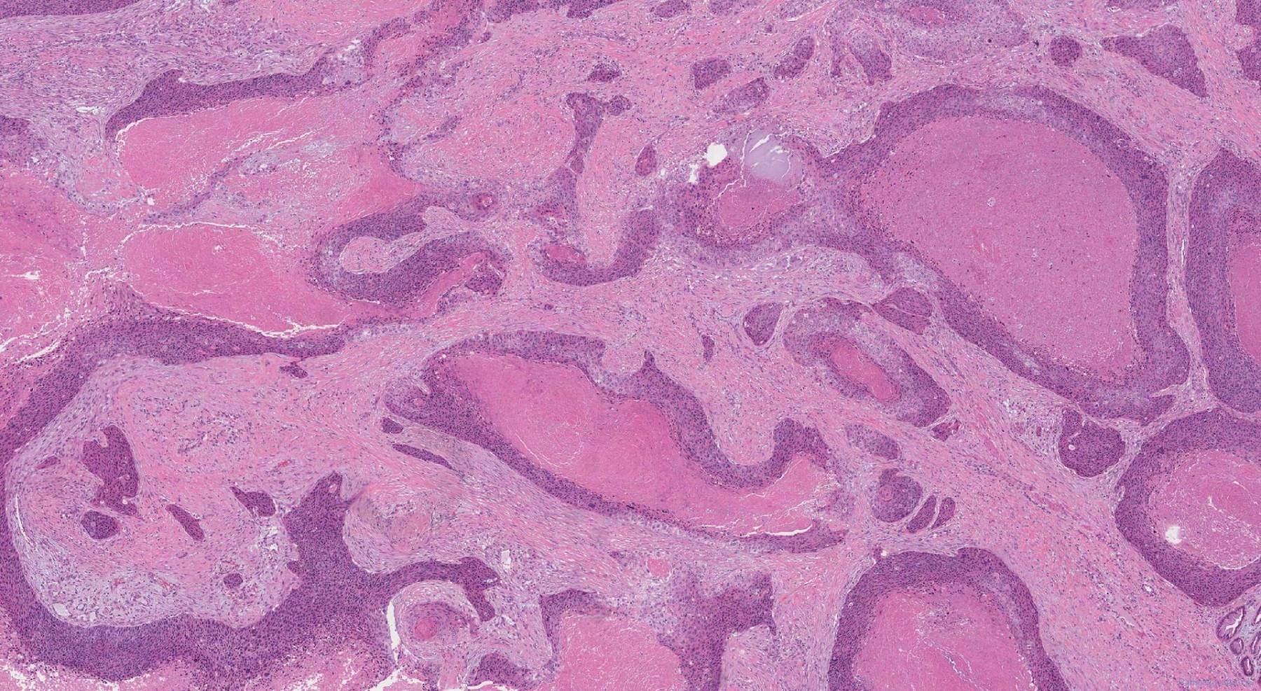 Hpv Associated Squamous Cell Carcinoma Of The Penis Ottawa Atlas Of Pathology