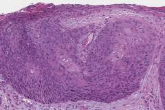 HPV-associated basaloid squamous cell carcinoma of the penis