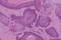 HPV-associated basaloid squamous cell carcinoma of the penis