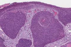 HPV-associated basaloid squamous cell carcinoma of the penis