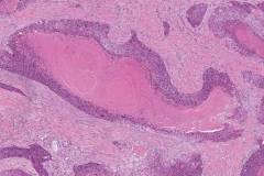 HPV-associated basaloid squamous cell carcinoma of the penis