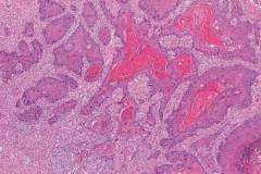 HPV-independent squamous cell carcinoma of the penis