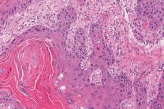 HPV-independent squamous cell carcinoma of the penis