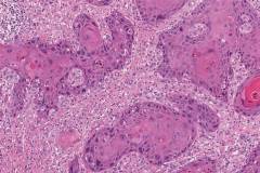 HPV-independent squamous cell carcinoma of the penis