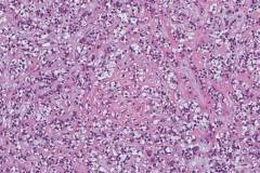 Metastatic hyalinizing clear cell carcinoma of the oropharynx to a lymph node