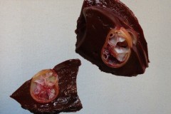 Hydatid cyst of the liver