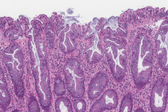 Hyperplastic polyp in the rectum