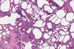 Hyperplastic polyp of the stomach