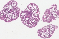 Hyperplastic polyp of the stomach