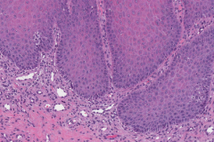 Hypertrophic candidiasis