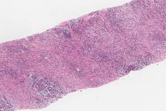 IgG4-mediated chronic sialadenitis