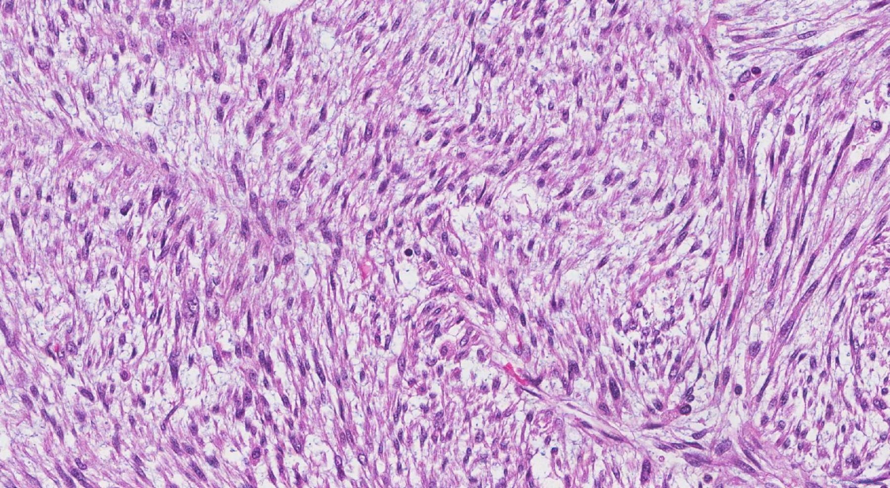 Inflammatory myofibroblastic tumour | Atlas of Pathology