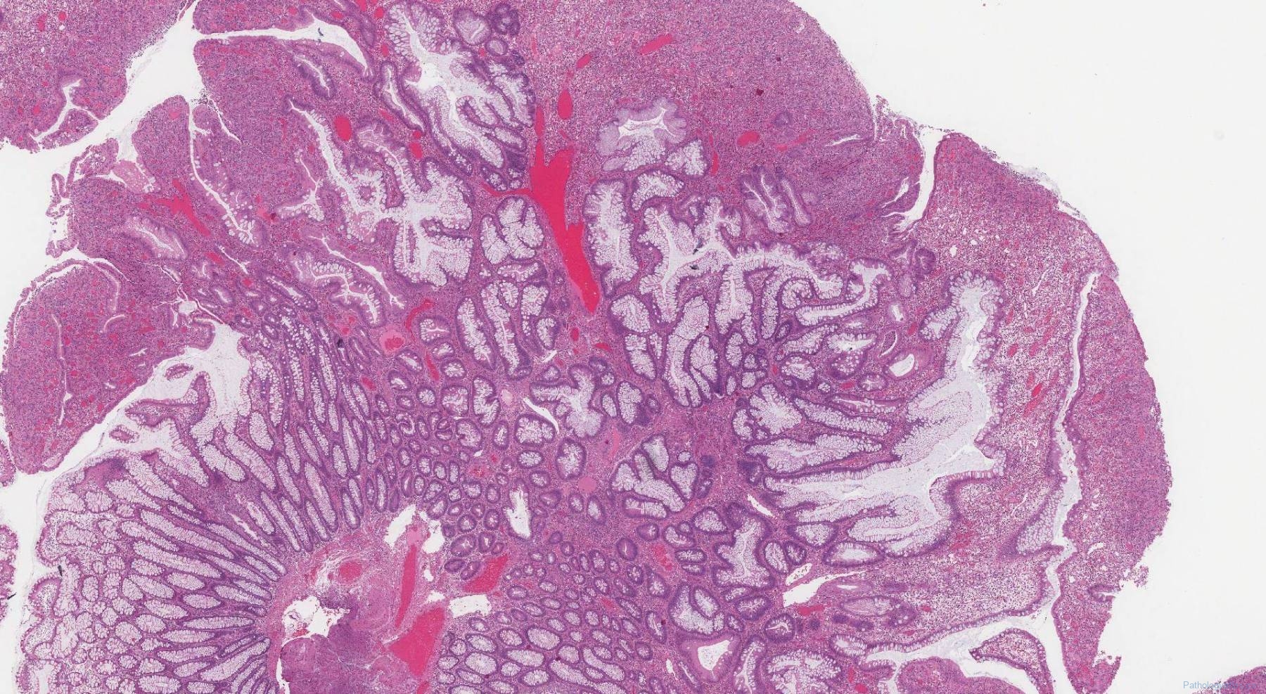 Inflammatory type polyp of the colon | Atlas of Pathology