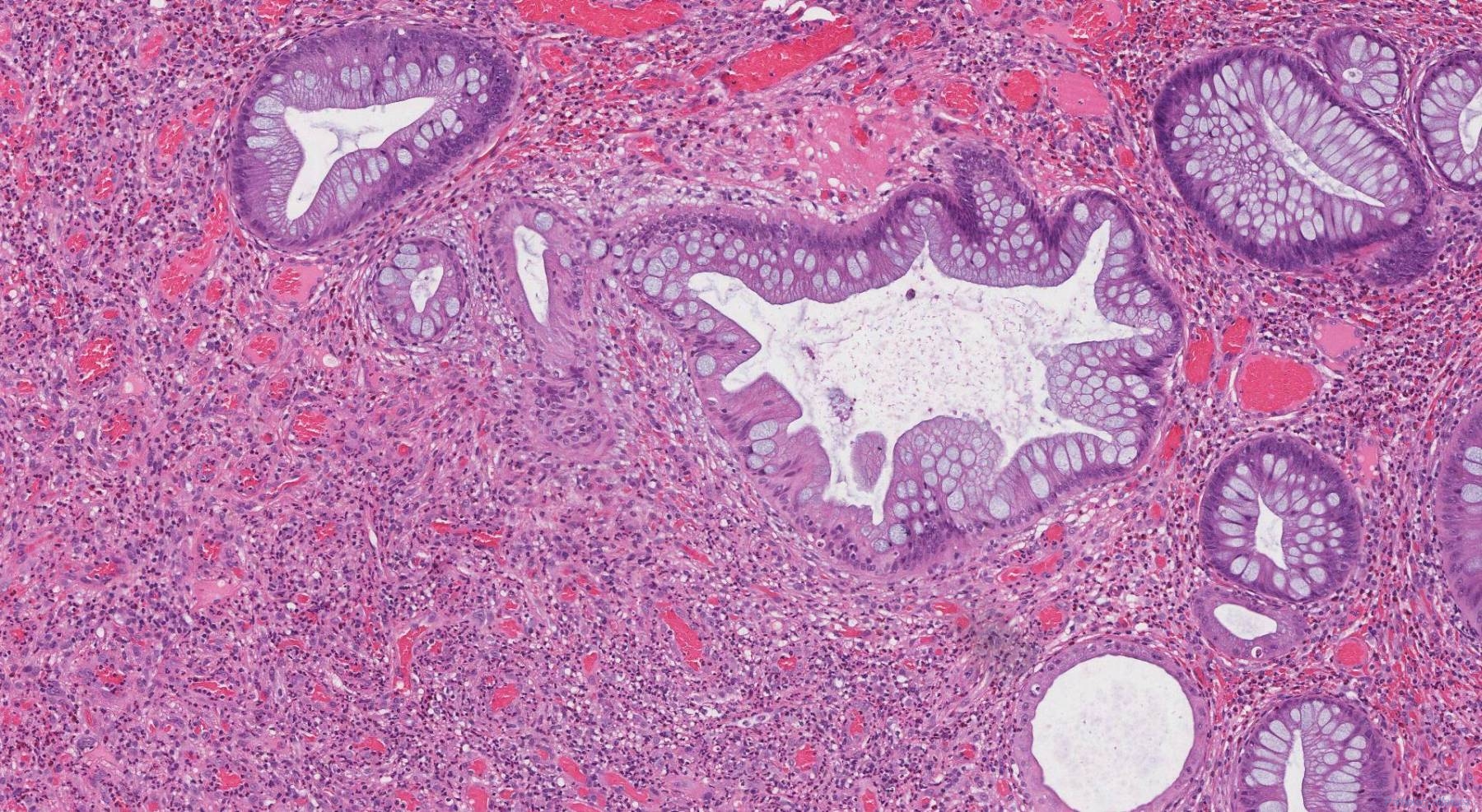 Inflammatory type polyp of the colon | Atlas of Pathology