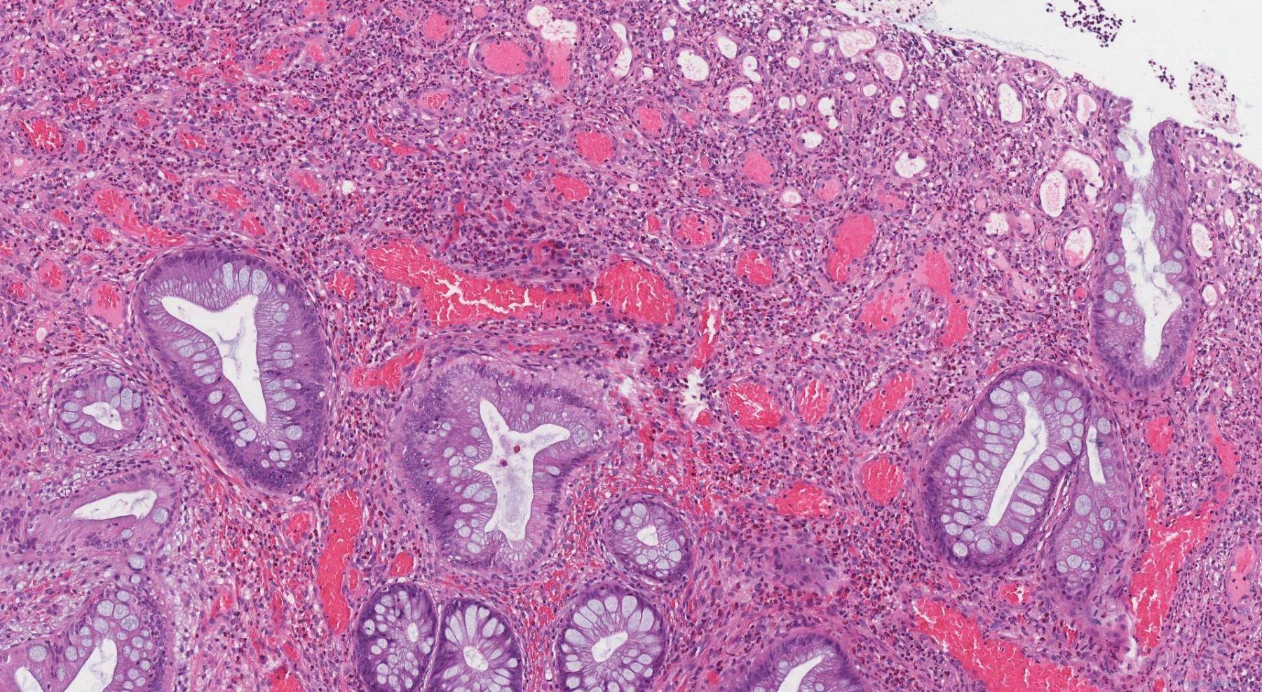 Inflammatory type polyp of the colon | Atlas of Pathology