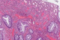 Inflammatory type polyp of the colon | Atlas of Pathology