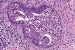 Intestinal-type sinonasal adenocarcinoma