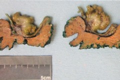 Intracholecystic papillary neoplasm
