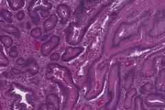 Intracholecystic papillary neoplasm: intestinal type