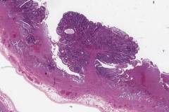 Intracholecystic papillary neoplasm: intestinal type