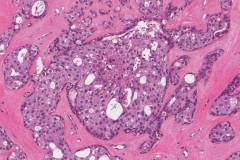 Apocrine type intraductal carcinoma arising from a pleomorphic adenoma