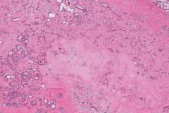 Apocrine type intraductal carcinoma arising from a pleomorphic adenoma