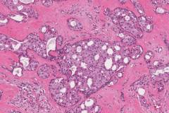 Apocrine type intraductal carcinoma arising from a pleomorphic adenoma