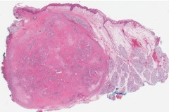 Apocrine type intraductal carcinoma arising from a pleomorphic adenoma