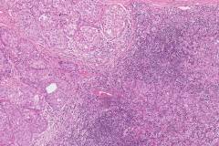 Apocrine type intraductal carcinoma with invasion