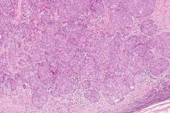 Apocrine type intraductal carcinoma