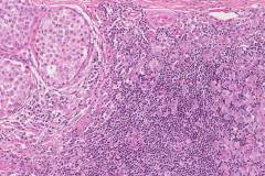 Apocrine type intraductal carcinoma with invasion